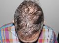 Click image for larger version

Name:	jg 8 yrs post-op chin down.jpg
Views:	253
Size:	94.8 KB
ID:	486764