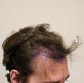 Click image for larger version

Name:	Pre op3.jpg
Views:	323
Size:	80.4 KB
ID:	487163