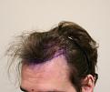 Click image for larger version

Name:	Pre op 4.jpg
Views:	323
Size:	82.3 KB
ID:	487164