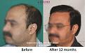 Dr-Pradeep-Sethi-Dr-Arika-Bansal-Eugenix-Result3.jpg