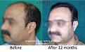 Dr-Pradeep-Sethi-Dr-Arika-Bansal-Eugenix-Result7.jpg