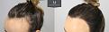 Click image for larger version

Name:	Before_After_left_hairline.jpg
Views:	215
Size:	95.1 KB
ID:	492210