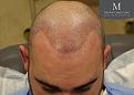 Click image for larger version

Name:	8Post-op_fron_tilt.jpg
Views:	375
Size:	68.6 KB
ID:	492220