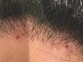 Click image for larger version

Name:	11 months Post-Op Pimples blood.jpg
Views:	299
Size:	89.1 KB
ID:	492292