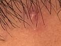 Click image for larger version

Name:	Pimple Day 2.jpg
Views:	440
Size:	77.9 KB
ID:	492293