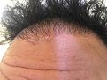 Click image for larger version

Name:	18 Months Post-Op Pimple Day 1.jpg
Views:	310
Size:	86.8 KB
ID:	492294