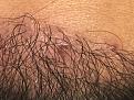 Click image for larger version

Name:	7 month postop Pimple 1.jpg
Views:	268
Size:	94.2 KB
ID:	492296