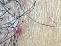 Click image for larger version

Name:	7 month postop Pimple 4.jpg
Views:	275
Size:	85.9 KB
ID:	492297