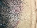 Click image for larger version

Name:	7 month postop Pimple 2.jpg
Views:	293
Size:	96.4 KB
ID:	492298