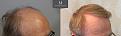 Click image for larger version

Name:	ID566_Before_After_right_hairline.jpg
Views:	263
Size:	97.1 KB
ID:	492302