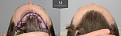 Click image for larger version

Name:	ID719-Before-after_above_hairine.jpg
Views:	461
Size:	97.4 KB
ID:	492416