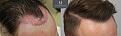Click image for larger version

Name:	ID719-Before-after_right45_graft-placement.jpg
Views:	977
Size:	98.7 KB
ID:	492419