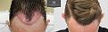 Click image for larger version

Name:	ID719-Before-after_hairline_graft_placement.jpg
Views:	459
Size:	101.1 KB
ID:	492420