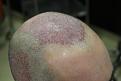 Click image for larger version

Name:	8-After_surgery_Hairline_right.jpg
Views:	262
Size:	86.4 KB
ID:	492675