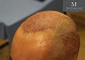Click image for larger version

Name:	9-After_Surgery_Left_Hairline.jpg
Views:	259
Size:	64.2 KB
ID:	492676