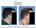 Click image for larger version

Name:	Patient 1755_RIGHT_FULL_800x629.jpg
Views:	201
Size:	55.5 KB
ID:	494212