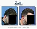 Click image for larger version

Name:	Patient 1755_RIGHT_45_DN_800x629.jpg
Views:	198
Size:	50.6 KB
ID:	494213