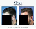 Click image for larger version

Name:	Patient 1755_LEFT_45_DN_800x629.jpg
Views:	192
Size:	47.1 KB
ID:	494214