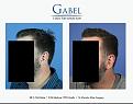 Click image for larger version

Name:	Patient 1755_LEFT_45_800x629.jpg
Views:	181
Size:	45.7 KB
ID:	494215
