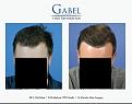 Click image for larger version

Name:	Patient 1755_FRONT45_800x629.jpg
Views:	217
Size:	44.4 KB
ID:	494216