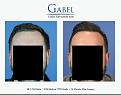 Click image for larger version

Name:	Patient 1755_FRONT_800x629.jpg
Views:	222
Size:	40.8 KB
ID:	494217