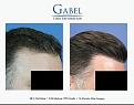 Click image for larger version

Name:	Patient 1755_CUHL_RT_800x629.jpg
Views:	199
Size:	53.2 KB
ID:	494218