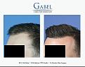 Click image for larger version

Name:	Patient 1755_CUHL_LF_800x629.jpg
Views:	198
Size:	48.0 KB
ID:	494219