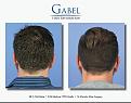 Click image for larger version

Name:	Patient 1755_BACK_800x629.jpg
Views:	187
Size:	54.5 KB
ID:	494220