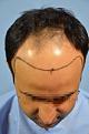 Click image for larger version

Name:	darling buds clinic hair transplant esult at 6 months in Indiia (3).jpg
Views:	203
Size:	8.3 KB
ID:	494495