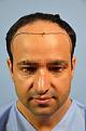 Click image for larger version

Name:	darling buds clinic hair transplant esult at 6 months in Indiia (4).jpg
Views:	270
Size:	8.1 KB
ID:	494496