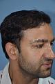 Click image for larger version

Name:	darling buds clinic hair transplant esult at 6 months in Indiia (1).jpg
Views:	278
Size:	8.0 KB
ID:	494501
