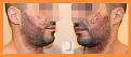 Click image for larger version

Name:	560 FUE postop.jpg
Views:	272
Size:	30.2 KB
ID:	494885