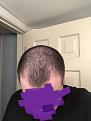 Click image for larger version

Name:	Hair Loss Beginning of Rogaine.jpg
Views:	189
Size:	80.9 KB
ID:	495173