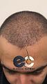 Click image for larger version

Name:	bf-5-dr-erkam-caymaz-hair-istanbul.jpg
Views:	206
Size:	96.7 KB
ID:	495589