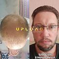 Click image for larger version

Name:	8-months-5200-graft-result.jpg
Views:	276
Size:	83.1 KB
ID:	496796