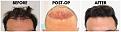 Click image for larger version

Name:	Before-Postop-After-Hairline.jpg
Views:	328
Size:	102.8 KB
ID:	499540