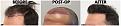 Click image for larger version

Name:	Before-Postop-After-LeftProfileAngle.jpg
Views:	287
Size:	108.8 KB
ID:	499542