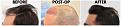 Click image for larger version

Name:	Before-Postop-After-LeftProfile.jpg
Views:	254
Size:	110.5 KB
ID:	499543