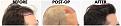 Click image for larger version

Name:	Before-Postop-After-RightProfile.jpg
Views:	271
Size:	110.2 KB
ID:	499545