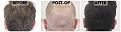 Click image for larger version

Name:	Before-Postop-After-Donor.jpg
Views:	250
Size:	107.0 KB
ID:	499547