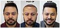 Click image for larger version

Name:	01-Before-Postop-After-Hairline.jpg
Views:	319
Size:	96.6 KB
ID:	499583