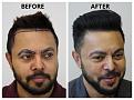 Click image for larger version

Name:	03-Before-After-RightProfileAngle.jpg
Views:	294
Size:	83.3 KB
ID:	499585