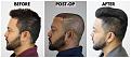 Click image for larger version

Name:	04-Before-Postop-After-LeftProfile.jpg
Views:	285
Size:	96.9 KB
ID:	499586