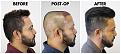 Click image for larger version

Name:	05-Before-Postop-After-RightProfile.jpg
Views:	282
Size:	96.2 KB
ID:	499587