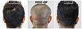Click image for larger version

Name:	06-Before-Surgical-After-Donor.jpg
Views:	275
Size:	101.2 KB
ID:	499588