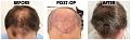 Click image for larger version

Name:	Before-Postop-After-Top.jpg
Views:	315
Size:	107.5 KB
ID:	499603