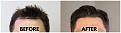 Click image for larger version

Name:	HairlineTakenByPatient2.jpg
Views:	156
Size:	94.3 KB
ID:	499656