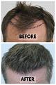 Click image for larger version

Name:	Before-After-HairlineCloseup.jpg
Views:	187
Size:	94.5 KB
ID:	499714