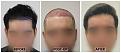 Click image for larger version

Name:	Hairline-6Months-Forum (1) copy.jpg
Views:	251
Size:	93.7 KB
ID:	499809