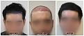 Click image for larger version

Name:	Hairline-9Months-Forum (1) copy.jpg
Views:	198
Size:	90.9 KB
ID:	499810